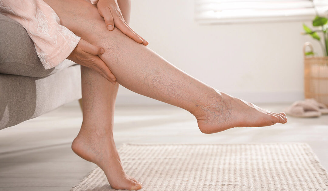 odpravi krčne žile ljubljana