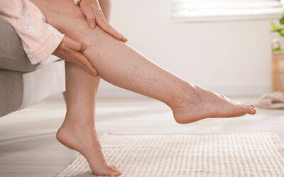 Varikozne ali krčne žile – vzroki in zdravljenje